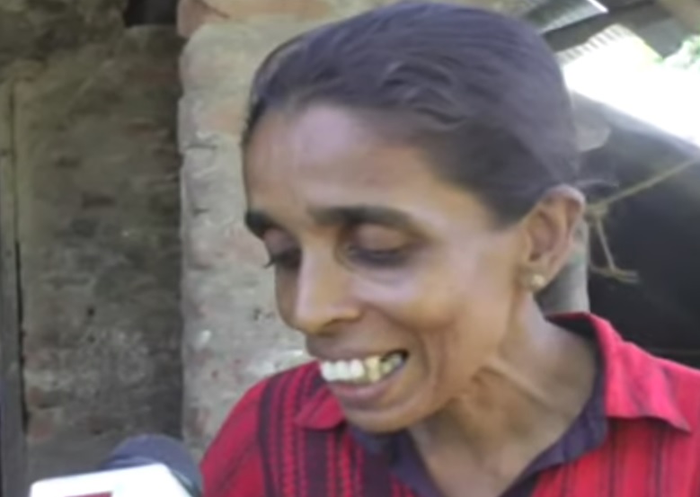 Mother suffering from malnutrition